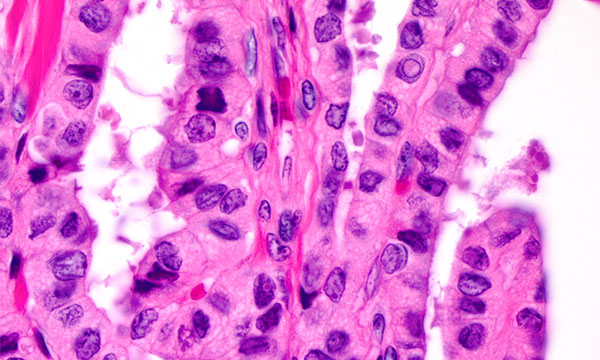Microscope slide of papillary thyroid carcinoma Microscope slide of papillary thyroid carcinoma