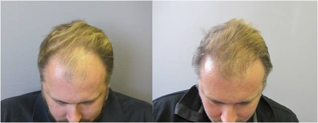Patients share photos of their hair to reveal the before-and-after transformation after receiving the Hair Restoration Surgery at the Massachusetts General Hospital Division of Plastic & Reconstructive Surgery. Patients share photos of their hair to reveal the before-and-after transformation after receiving the Hair Restoration Surgery at the Massachusetts General Hospital Division of Plastic & Reconstructive Surgery.