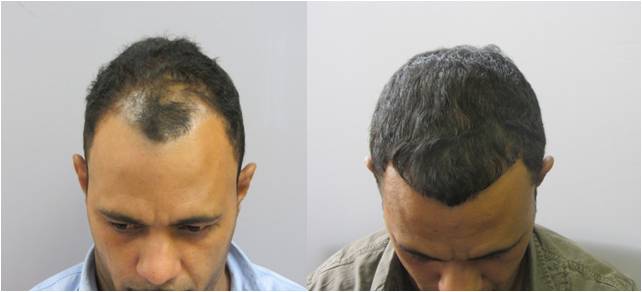 Patients share photos of their hair to reveal the before-and-after transformation after receiving the Hair Restoration Surgery at the Massachusetts General Hospital Division of Plastic & Reconstructive Surgery. Patients share photos of their hair to reveal the before-and-after transformation after receiving the Hair Restoration Surgery at the Massachusetts General Hospital Division of Plastic & Reconstructive Surgery.
