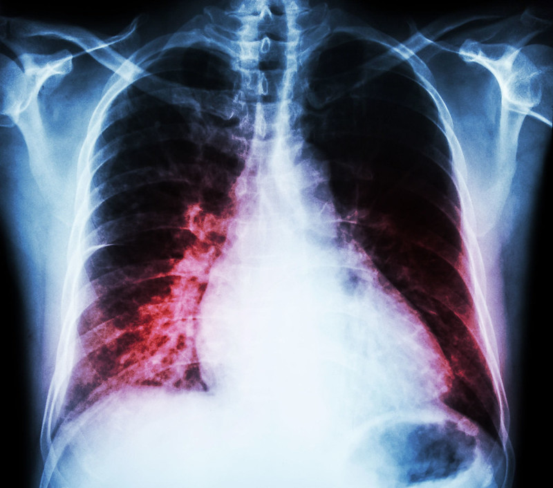 X-ray of a lung with cancer X-ray of a lung with cancer