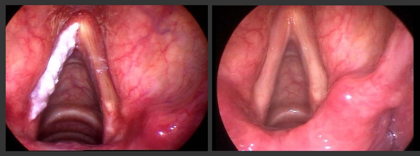 A patient with precancerous vocal cord dysplasia, before (left) and after (right) surgical treatment. A patient with precancerous vocal cord dysplasia, before (left) and after (right) surgical treatment.
