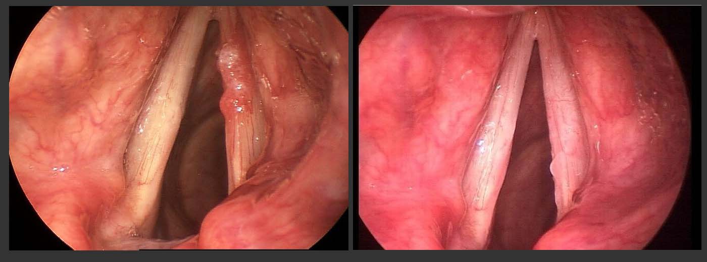 A patient with precancerous vocal cord dysplasia, before (left) and after (right) surgical treatment. A patient with precancerous vocal cord dysplasia, before (left) and after (right) surgical treatment.