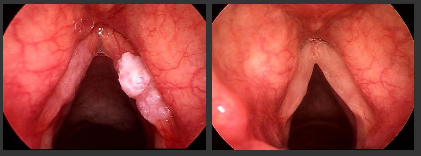 A patient with precancerous vocal cord dysplasia, before (left) and after (right) surgical treatment. A patient with precancerous vocal cord dysplasia, before (left) and after (right) surgical treatment.