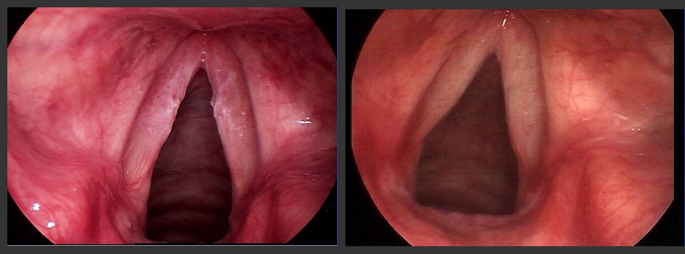 A patient with precancerous vocal cord dysplasia, before (left) and after (right) surgical treatment. A patient with precancerous vocal cord dysplasia, before (left) and after (right) surgical treatment.