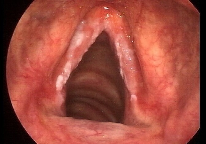 An example of leukoplakia. An example of leukoplakia.