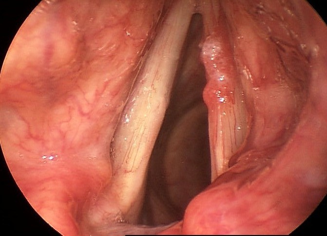 An example of erythroplasia. An example of erythroplasia.