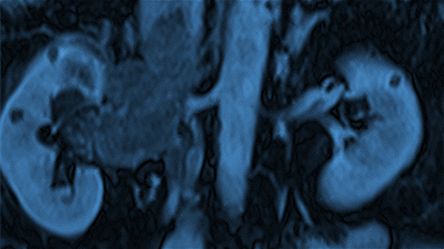 Research and Clinical Trials Click here to learn about research at Mass General Urology.